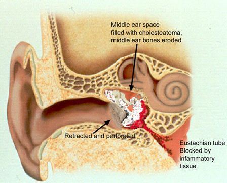 mastoidectomy
