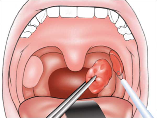 tonsillectomy adenoidectomy