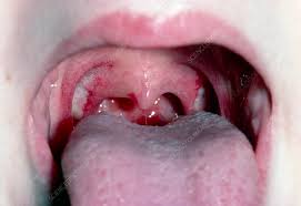 tonsillectomy