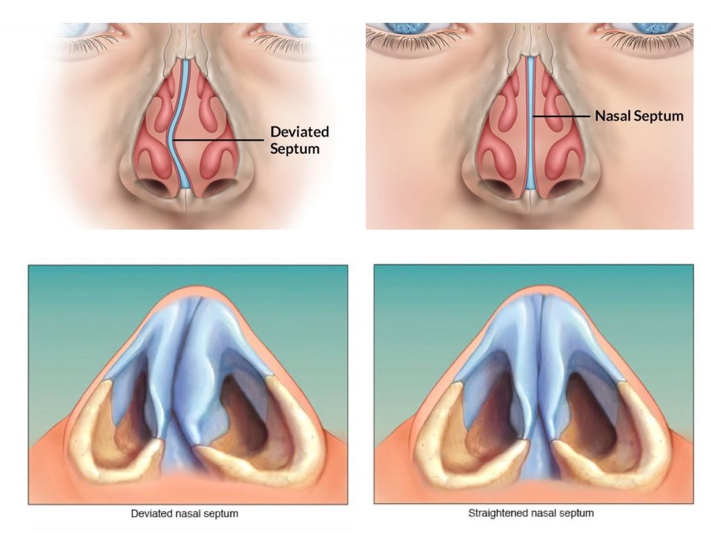 deviated and straightened septum 1024x768