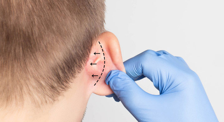 otoplasty ear surgery