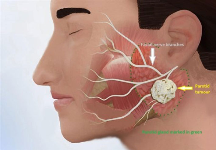 parotid
