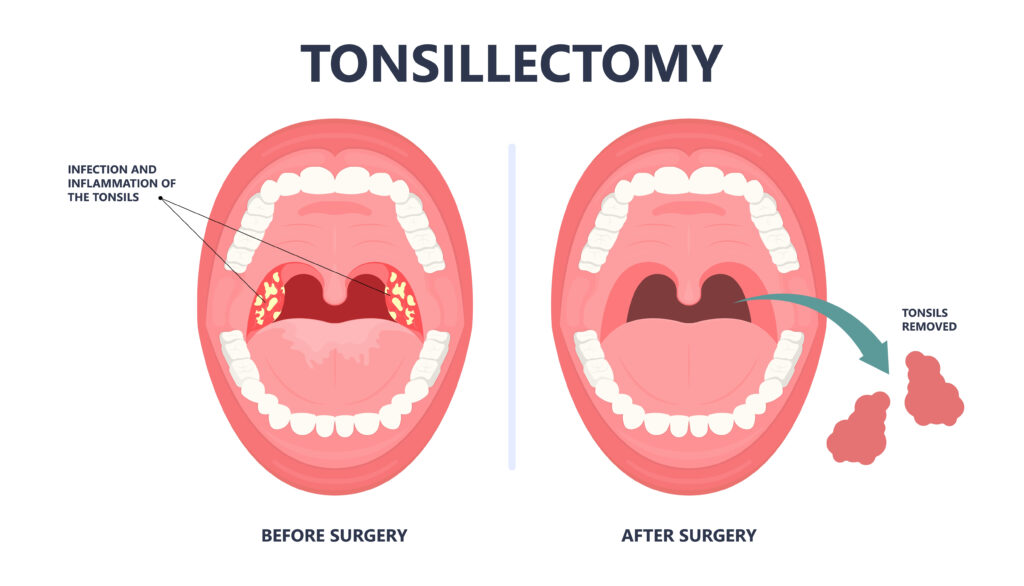tonsil,stones,crypts,viral,virus,gland,strep,throat,sore,enlarged