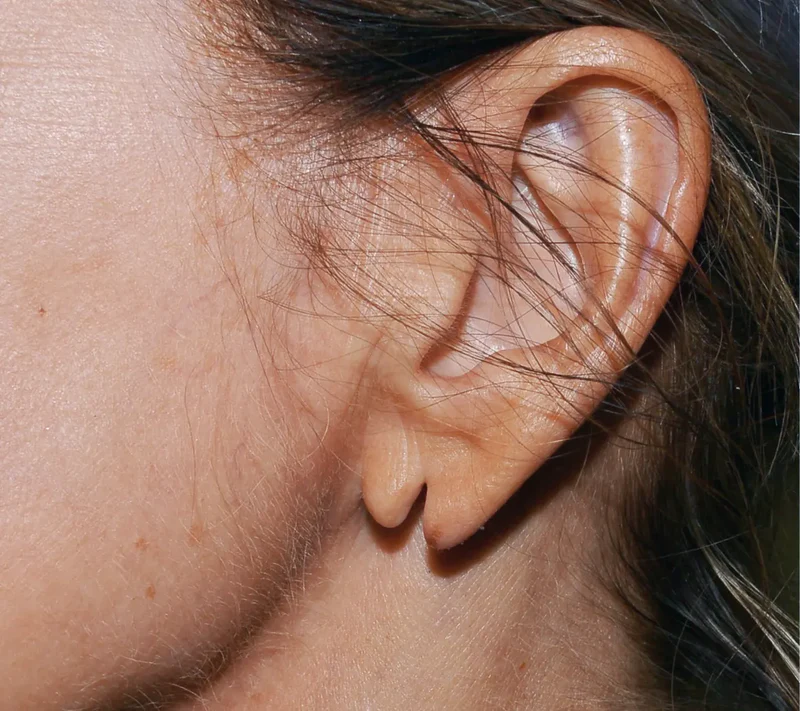 split earlobe repair bondi sydney